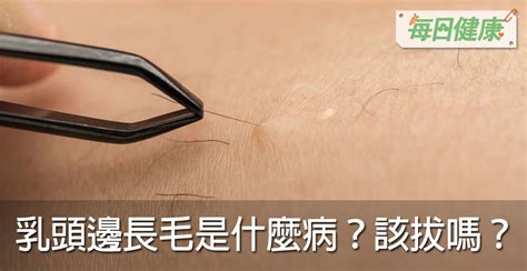 乳房有毛|乳頭邊長了毛，是什麼病？該不該拔？讓名醫一次解釋給您聽｜每